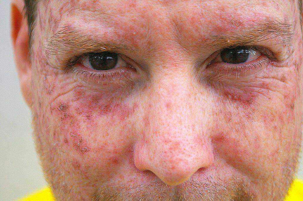 Vams reccomend Facial skin symptoms