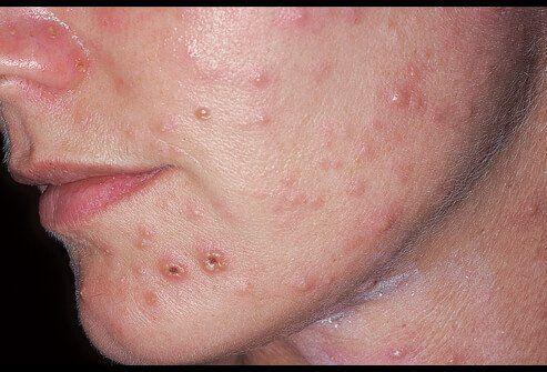 SвЂ™Mores reccomend Facial zoster or shingles rash