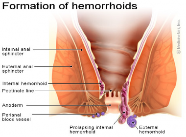 Hemorrhoids knot next to anus Free Video 18+ 2018
