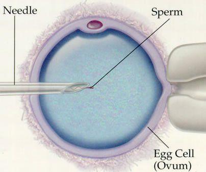Icsi intracytoplasmic sperm injection