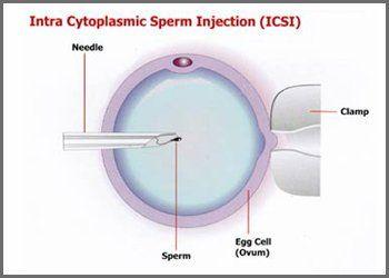 Beamer reccomend Icsi intracytoplasmic sperm injection