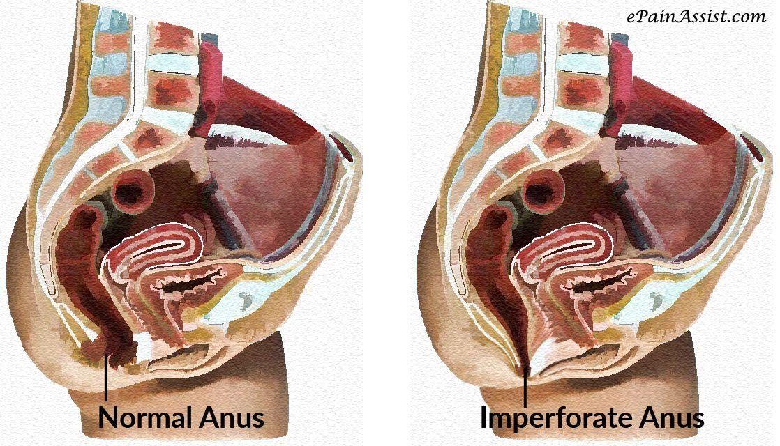 Pediatric imperforate anus