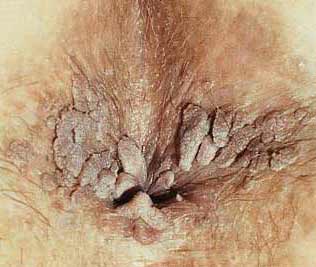 Pictures of hpv anal warts