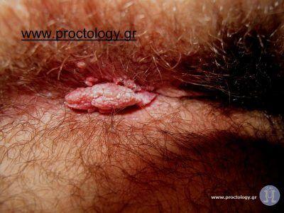 Pictures of hpv anal warts