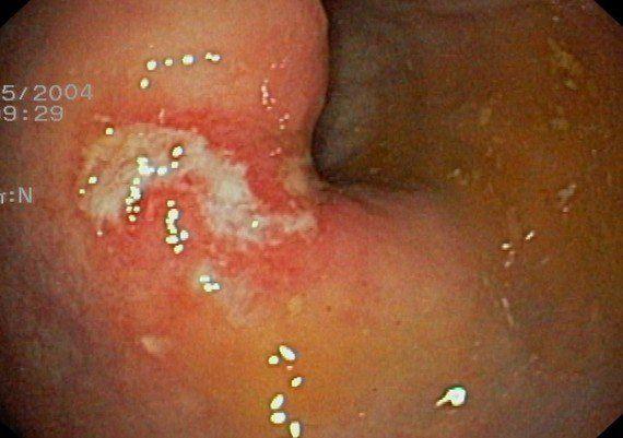 Evil E. reccomend Ulcer on anus